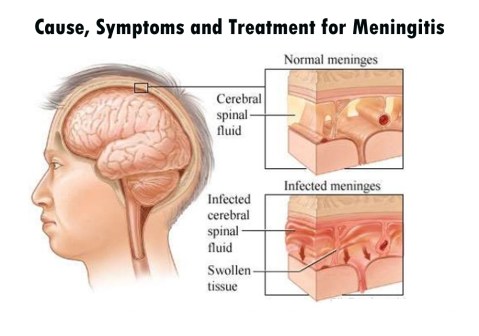 meninggitis