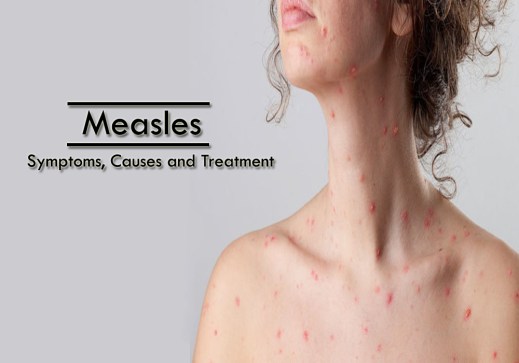 Measles
