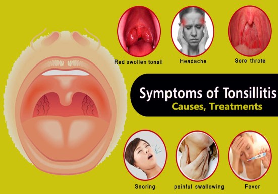 Tonsils-symptoms-causes-treatments
